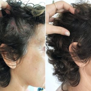 Woman with hair loss using product to cover it up Woman with hair loss using product to cover it up
